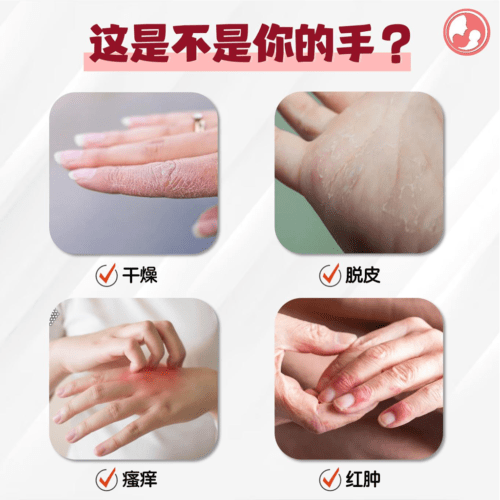 清洗宝宝用品后，手常常干燥，脱皮，瘙痒和红肿